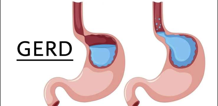GERD | El Paso Texas Chiropractor